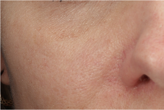 Lentigo Solaris beter bekend als levervlek na behandeling