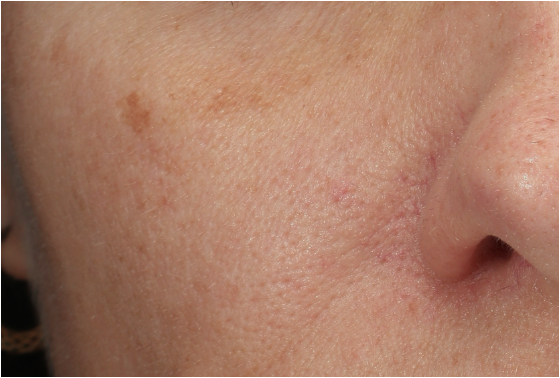 Lentigo Solaris beter bekend als levervlek voor behandeling