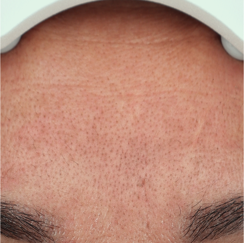 Foto van vergrote porien voor behandeling