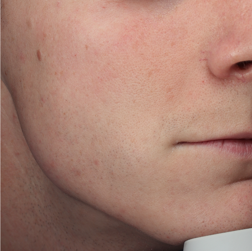 Huid van een jongeman met een neus-lippenplooi na behandeling met Fillers