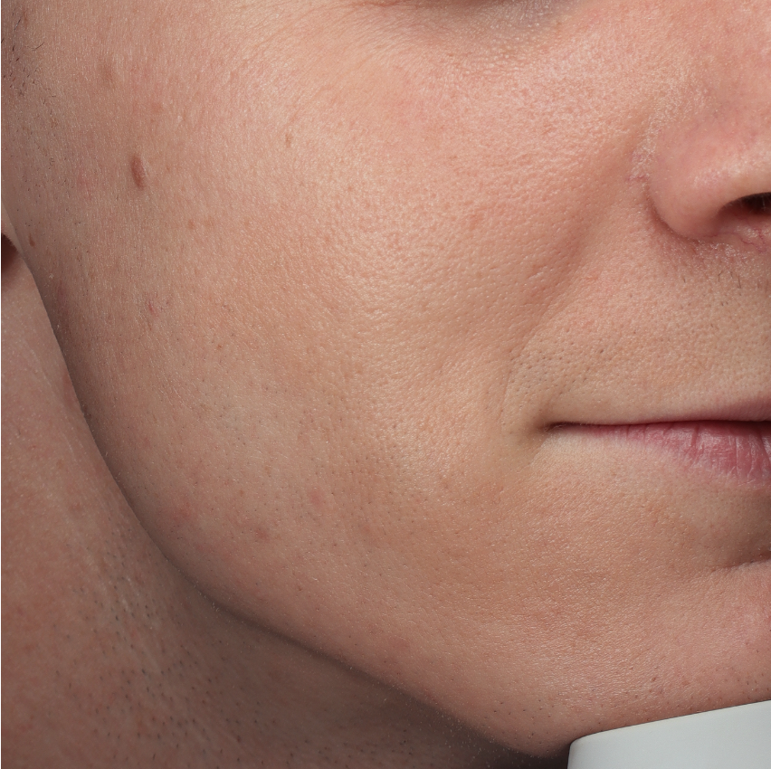 Huid van een jongeman met een neus-lippenplooi voor behandeling met Fillers