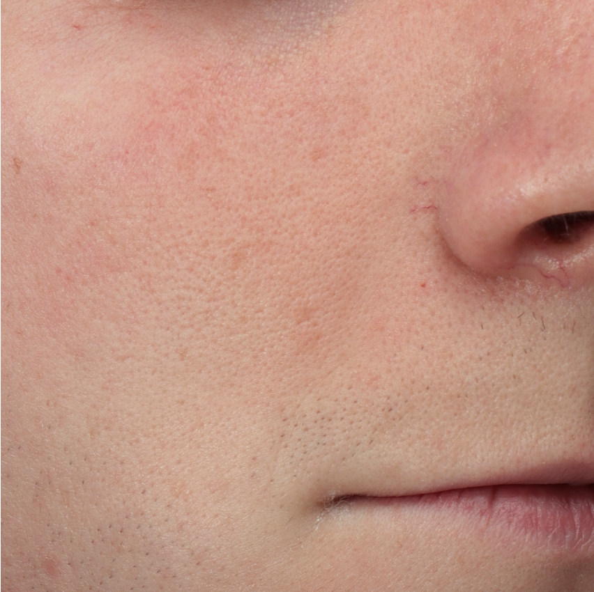 Huid van een jongeman met een neus-lippenplooi na behandeling met Fillers