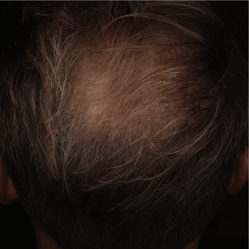 AGA - AFTER patient 1