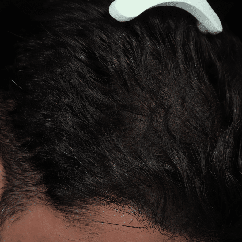 AGA - AFTER patient 1 OVERZICHT