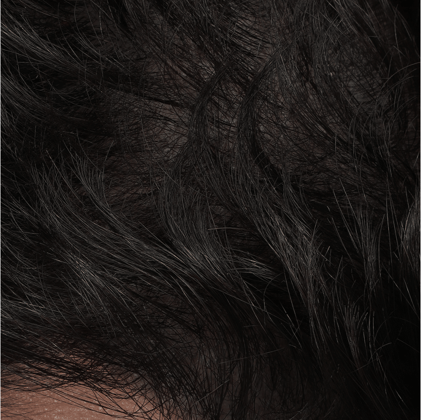 AGA - AFTER patient 2 DETAIL