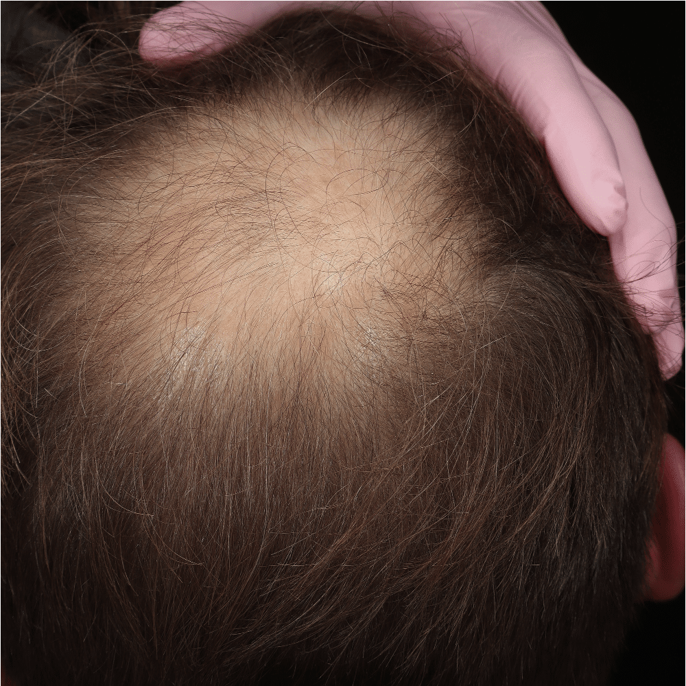 AGA - BEFORE patient 1