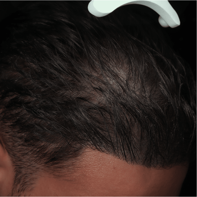 AGA - BEFORE patient 2 OVERZICHT