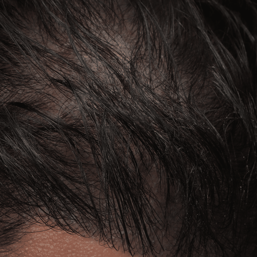 AGA - BEFORE patient 2