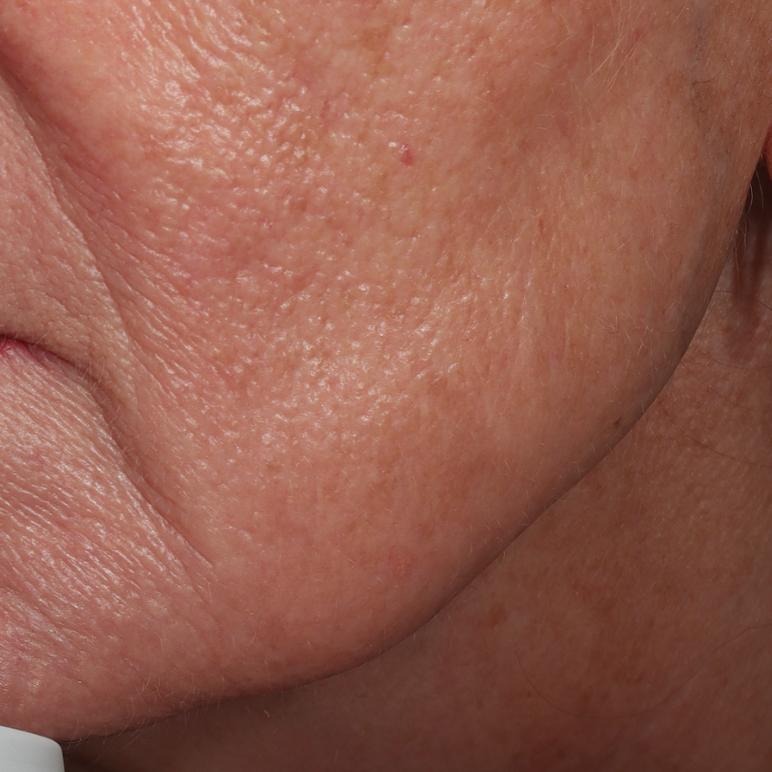 Verstrakte kaaklijn (links) van een mevrouw na behandeling met fillers