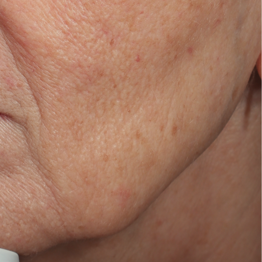 Verslapte kaaklijn (links) van een mevrouw voor de behandeling met fillers