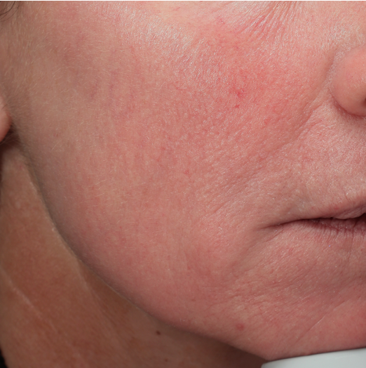 Versterkte kaaklijn van een mevrouw (rechts) na de behandeling met fillers