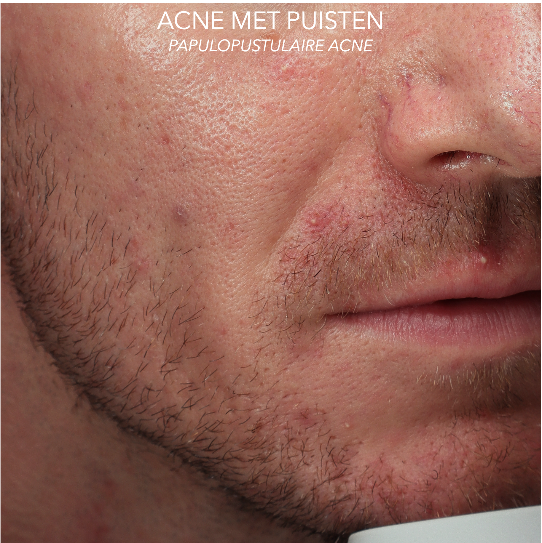 ACNE MET PUISTEN EN PUKKELS GEZICHT (PAPULOPUSTULAIRE ACNE) VOOR BEHANDELING