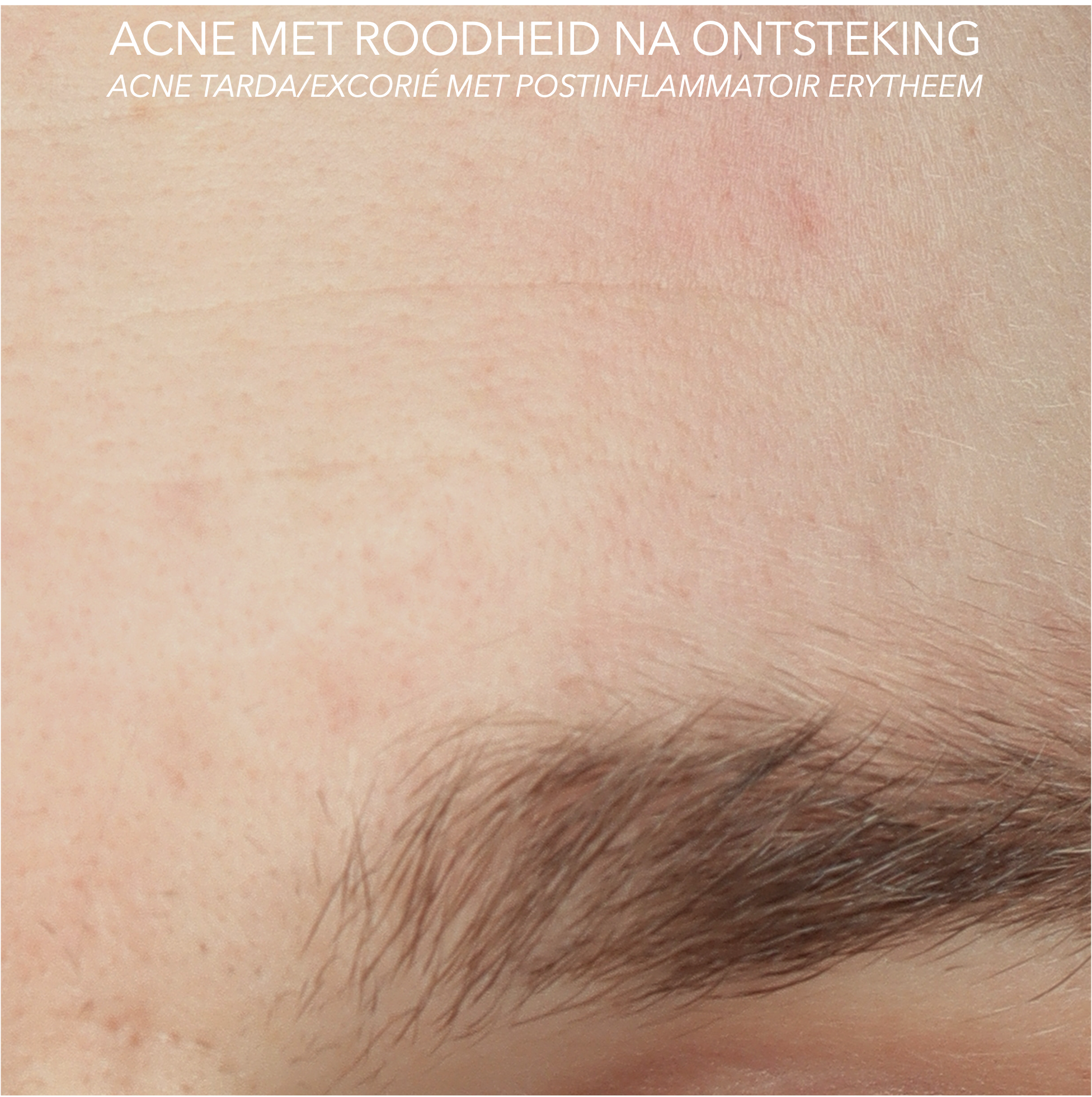 ACNE TARDA GEZICHT MET POSTINFLAMMATOIR ERYTHEEM VOOR BEHANDELING