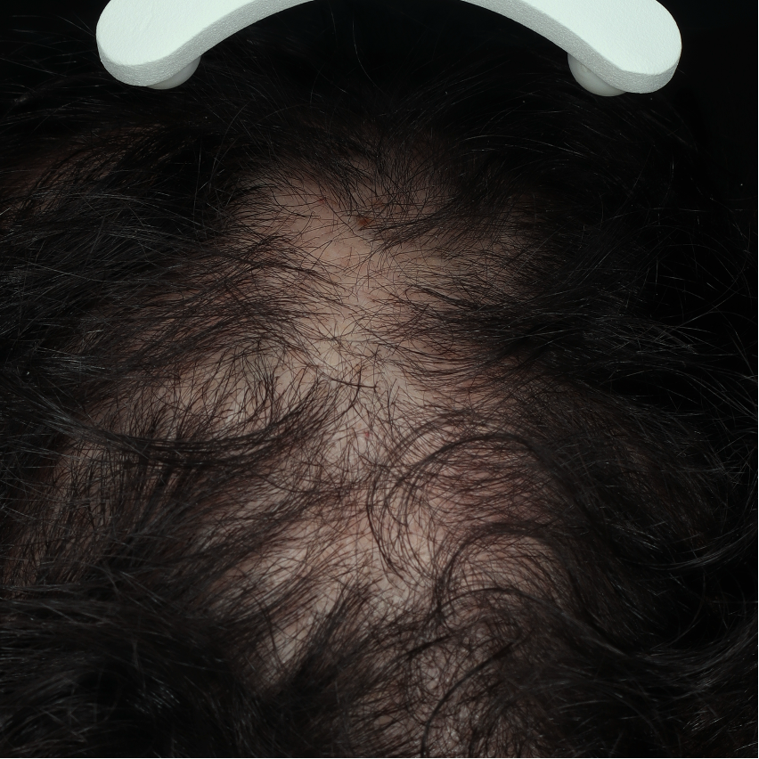 Diffuse alopecia areata