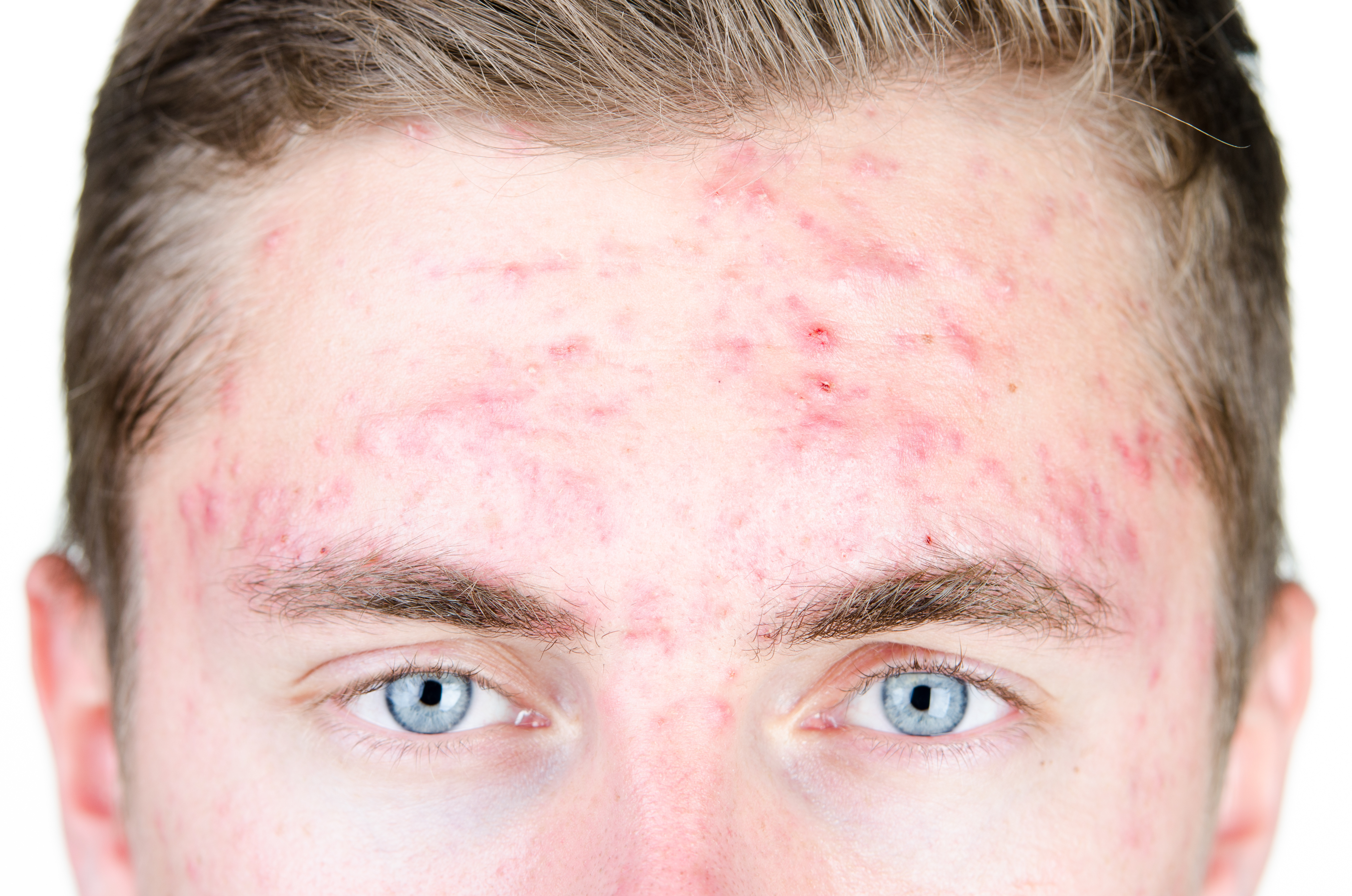 Acne papulopustulosa