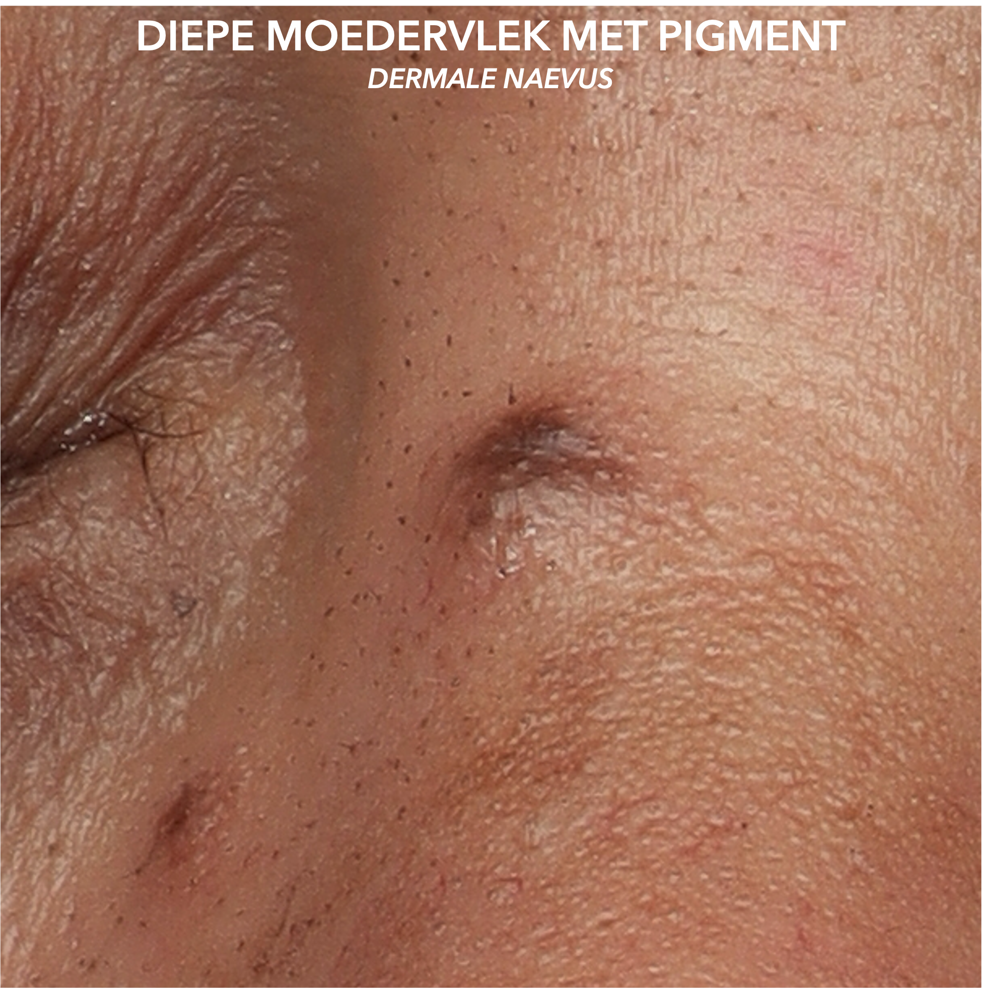 Samengestelde naevus