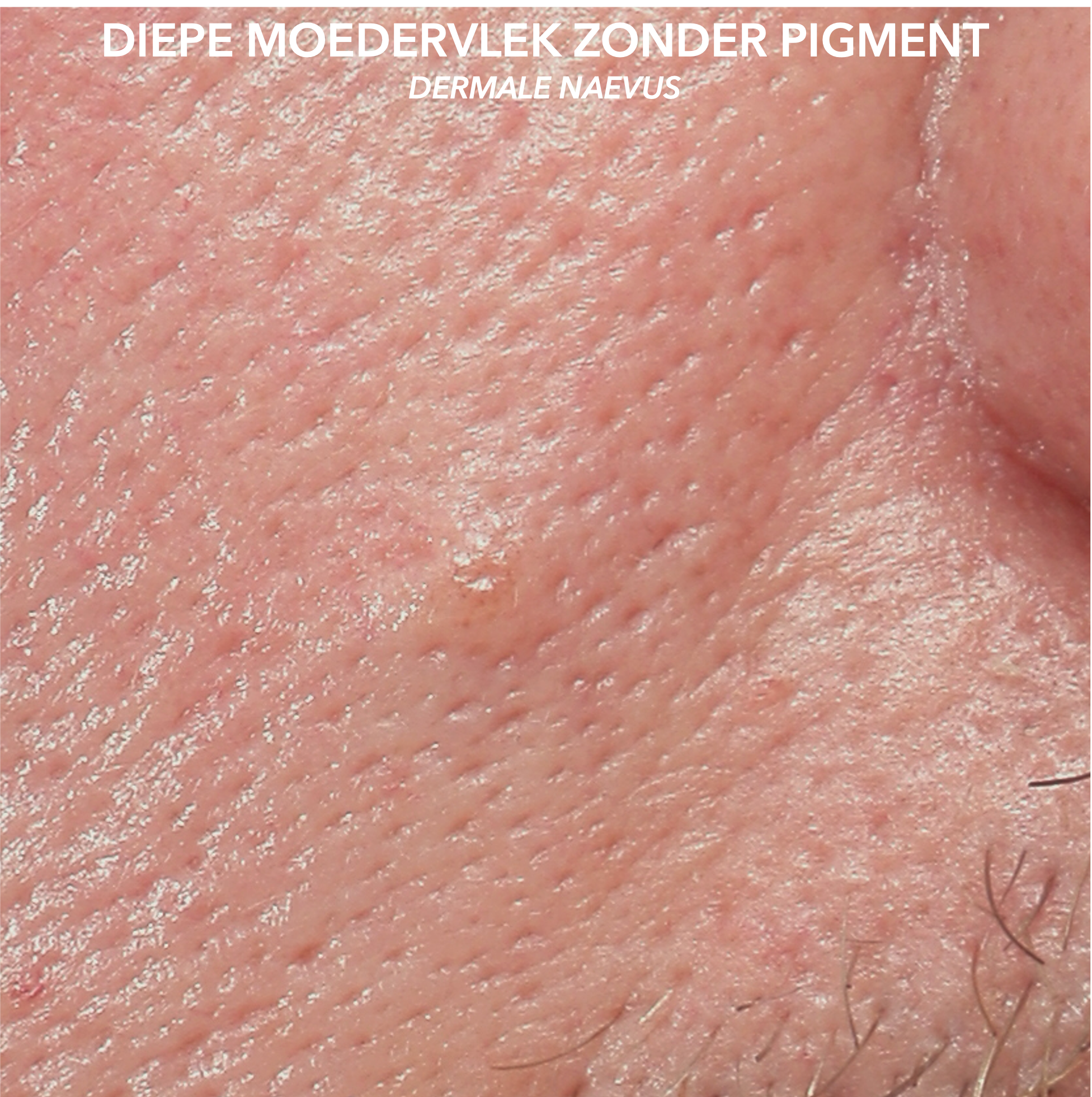 Dermale naevus zonder pigment