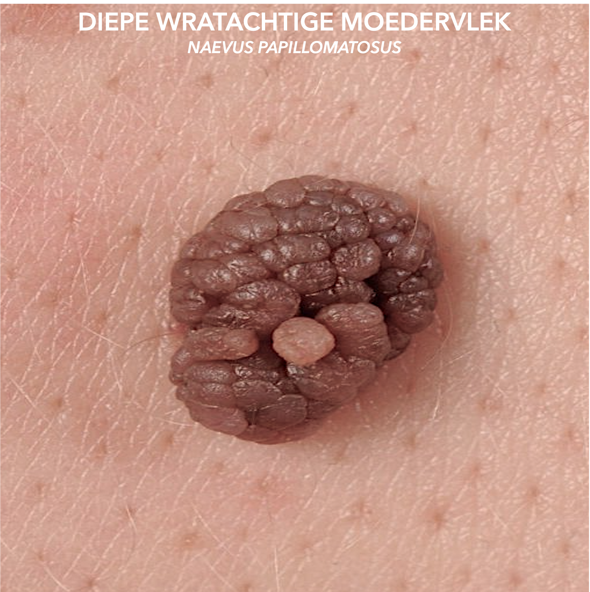 Papillomateuze naevus