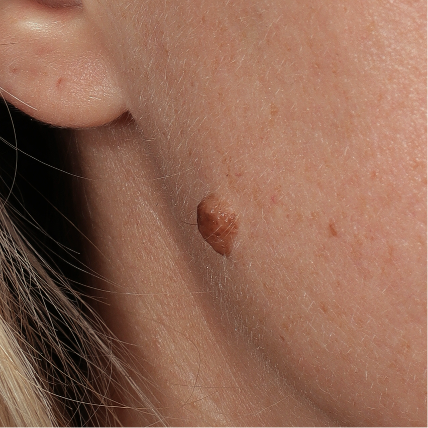 Dermale naevus met pigment