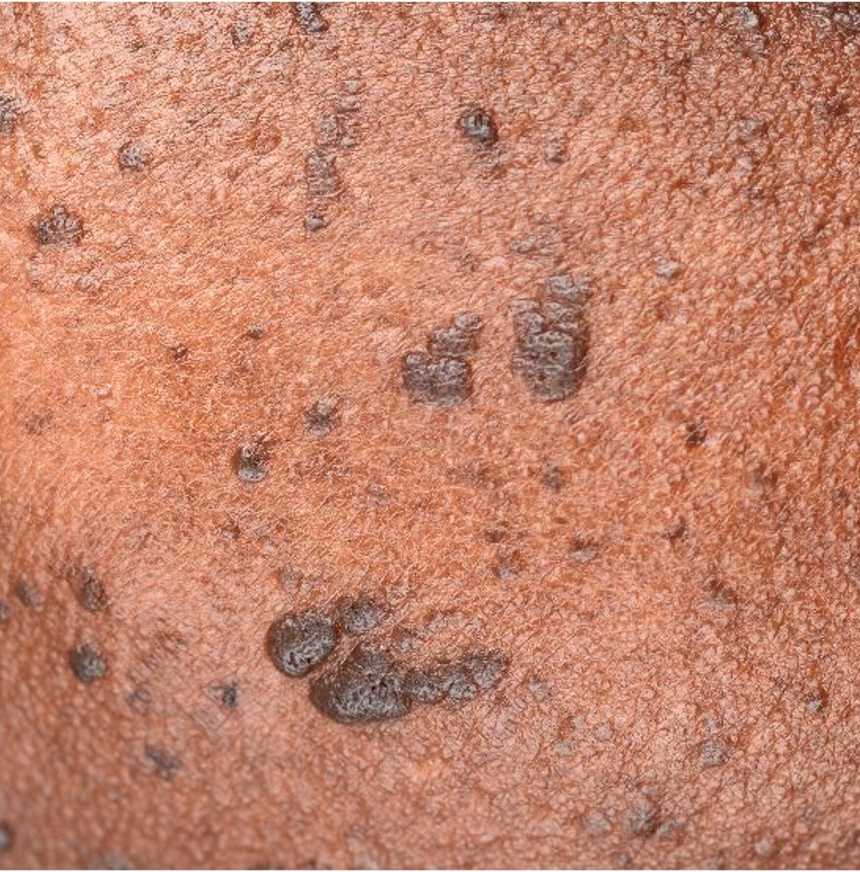 Dermatosis papulose nigra