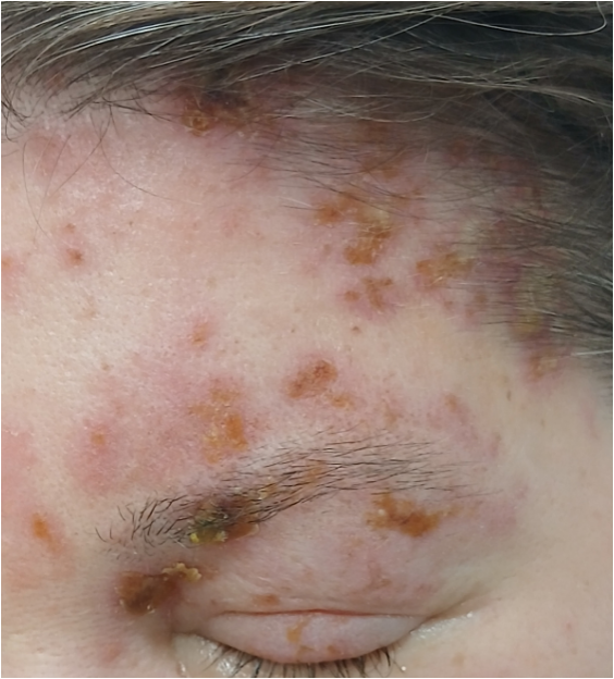 Zeldzame bijwerkingen