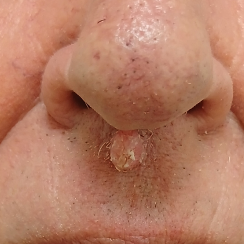 Inverted follicular keratosis