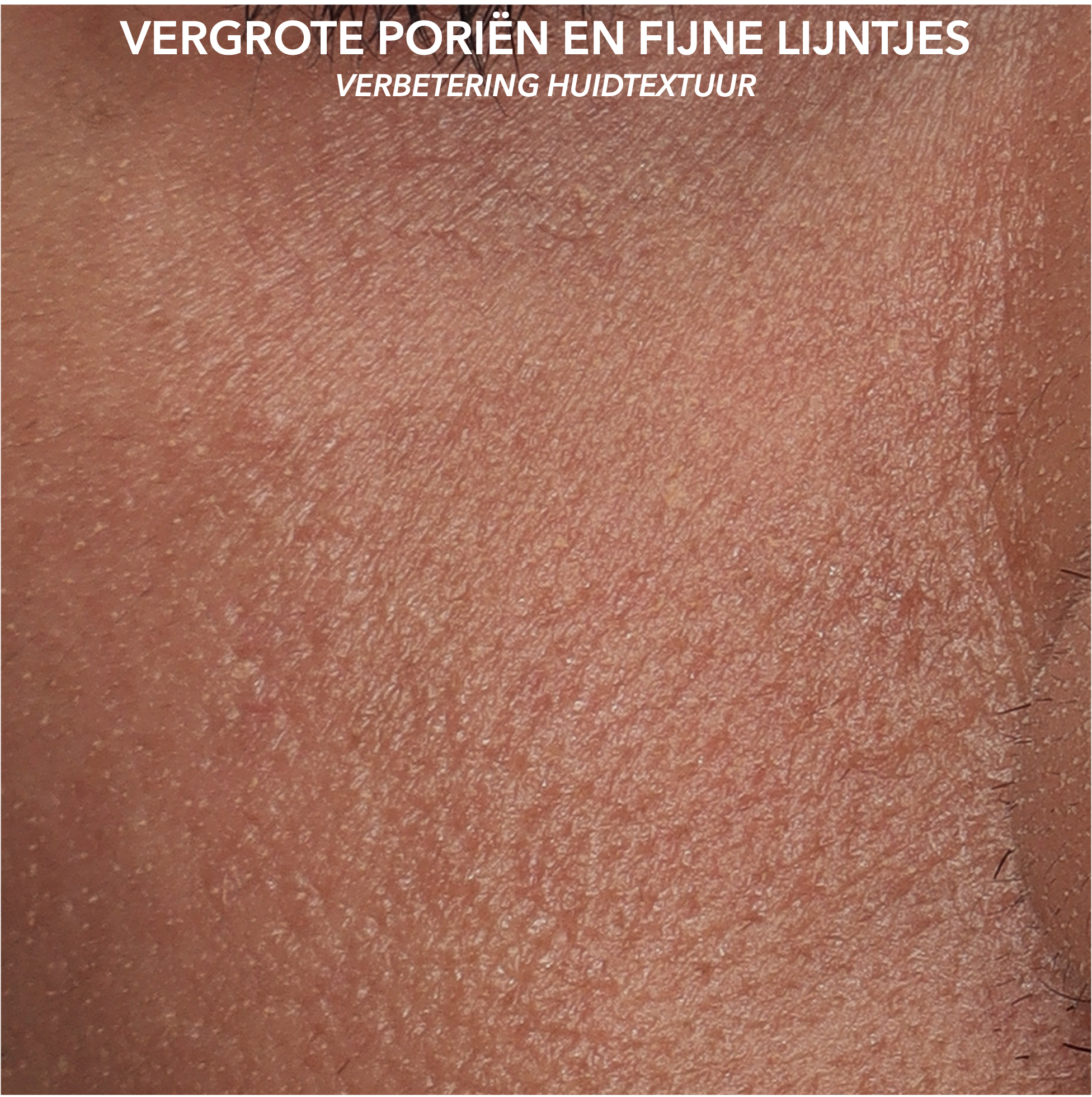 MICROTOX - PORIEN - AFTER