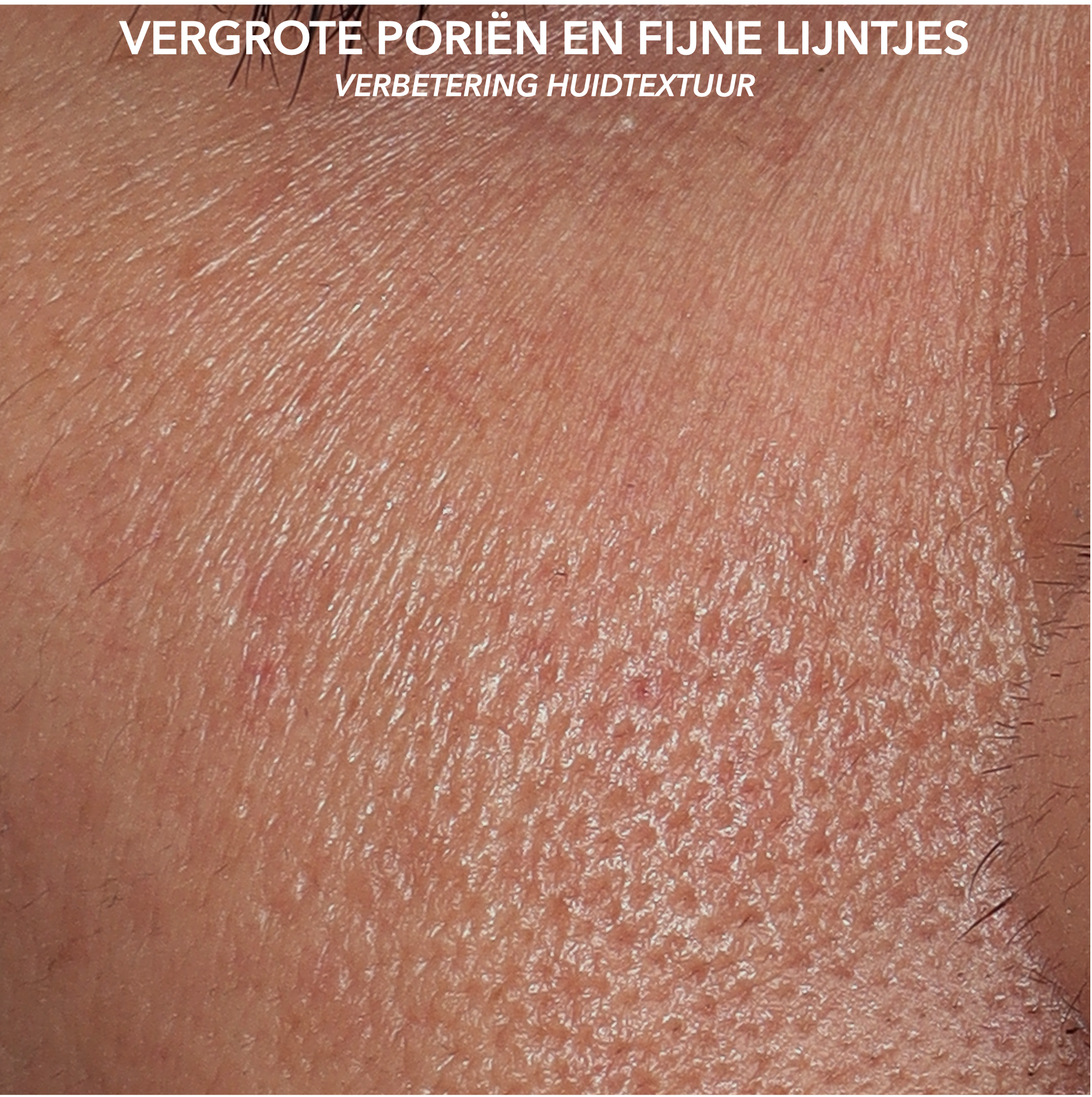 MICROTOX - PORIEN - BEFORE