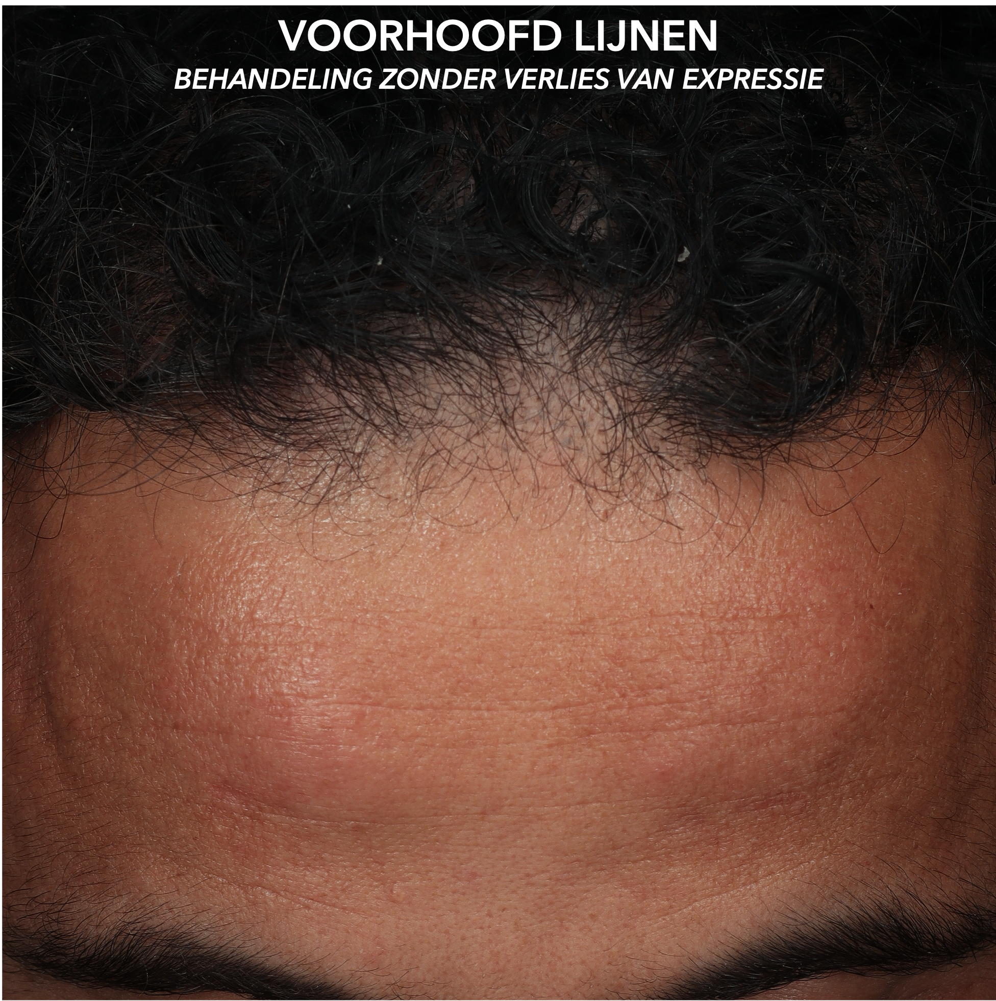 MICROTOX - VOORHOOFDLIJNEN - BEFORE