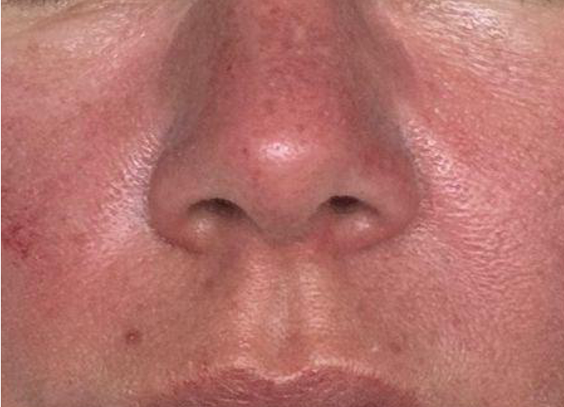 Bijwerkingen direct na behandeling