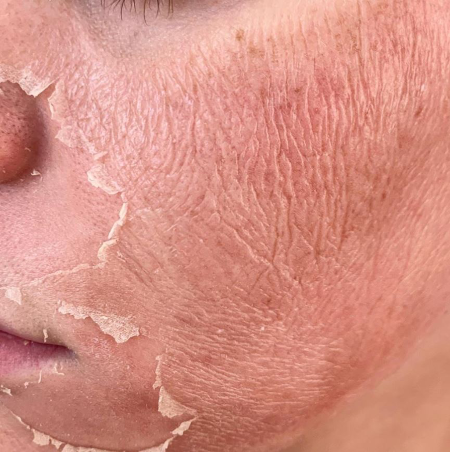 Bijwerkingen direct na behandeling