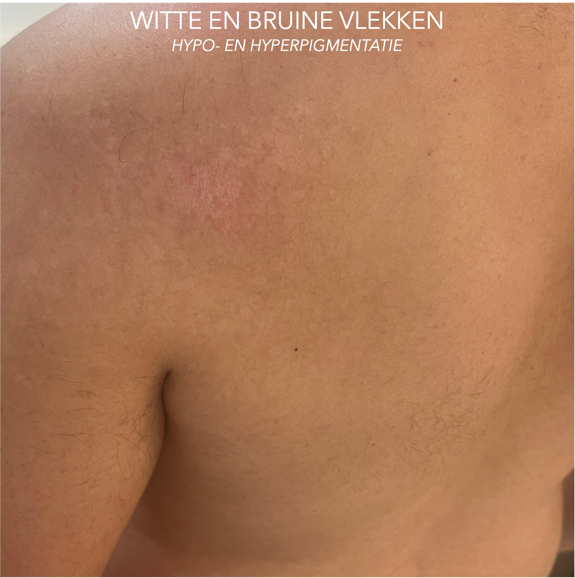PITYRIASIS VERSICOLOR oftewel zomergist rug en schouders