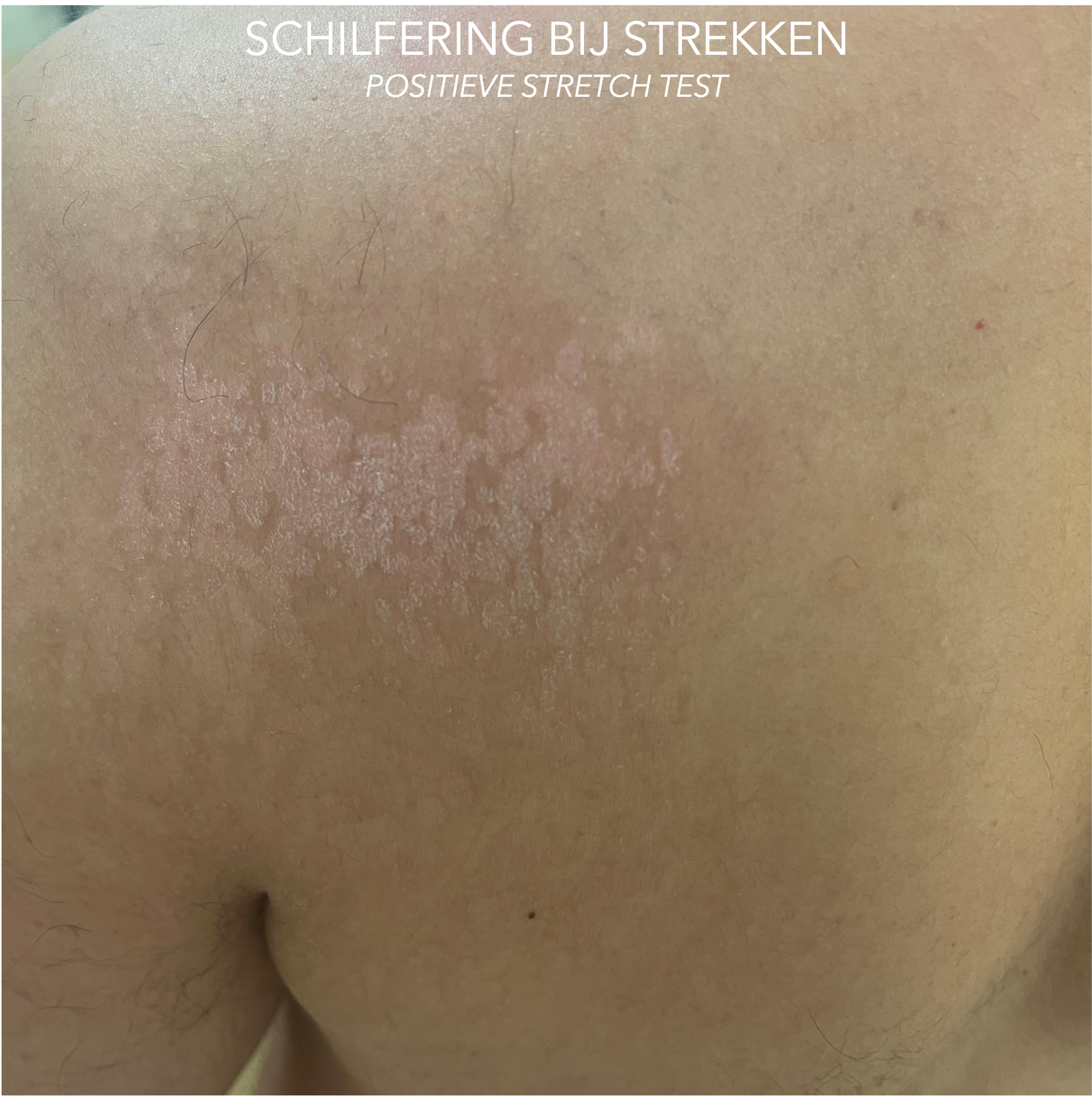 PITYRIASIS VERSICOLOR oftewel zomergist rug en schouders