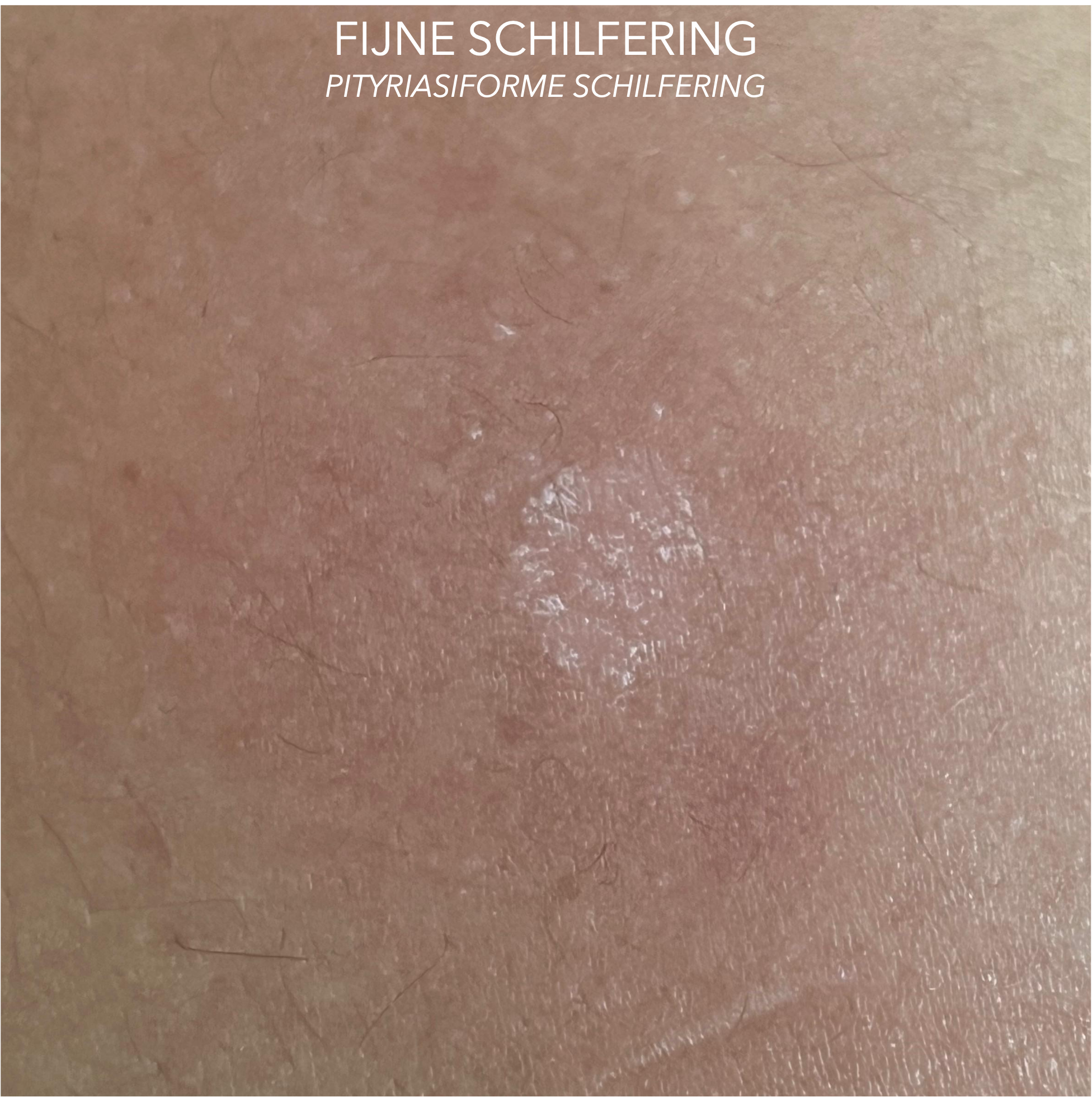 PITYRIASIS VERSICOLOR oftewel zomergist rug en schouders