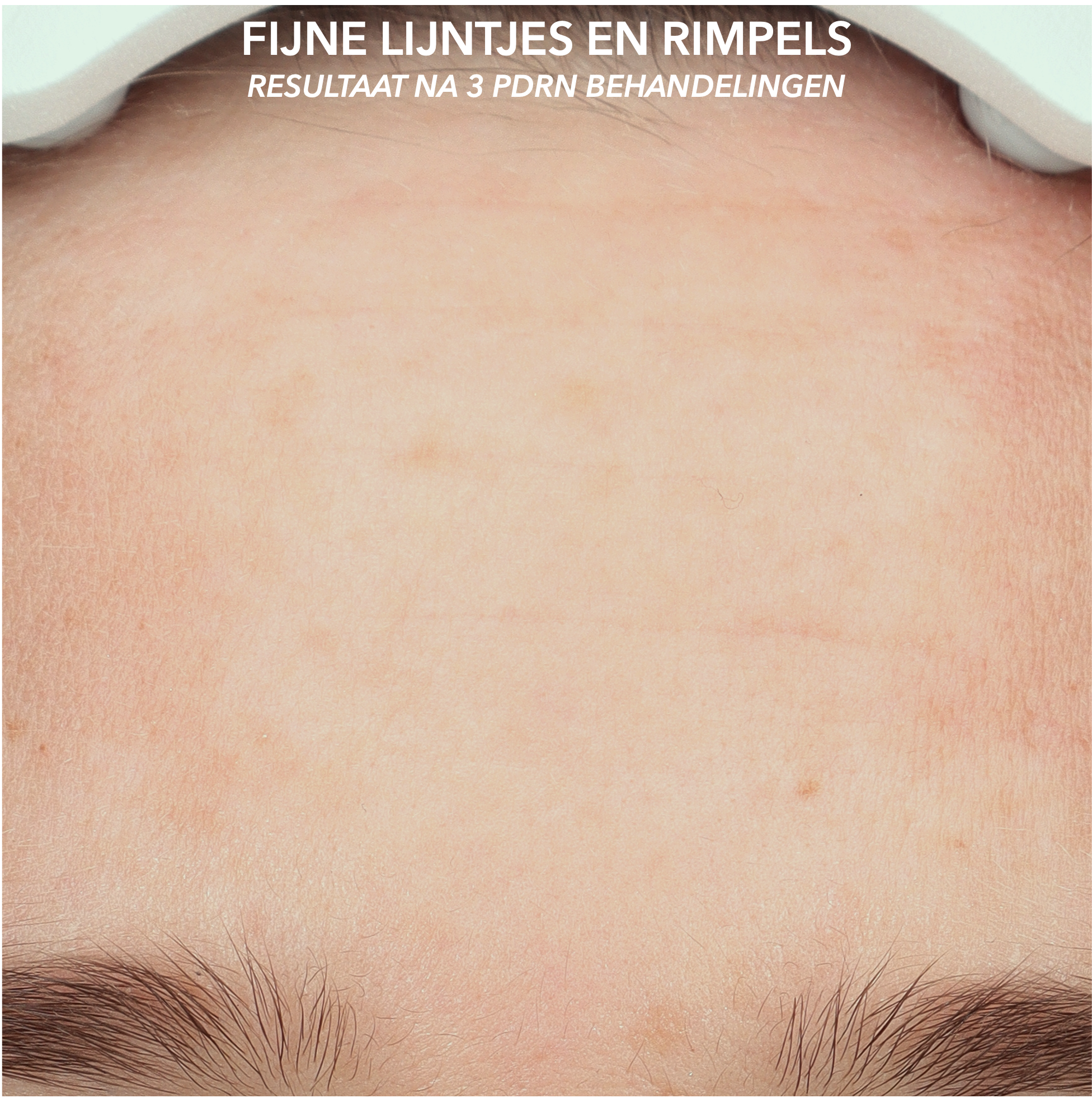 Effect van polynucleotiden op fijne lijntjes en rimpels in het gezicht na driemaal behandeling