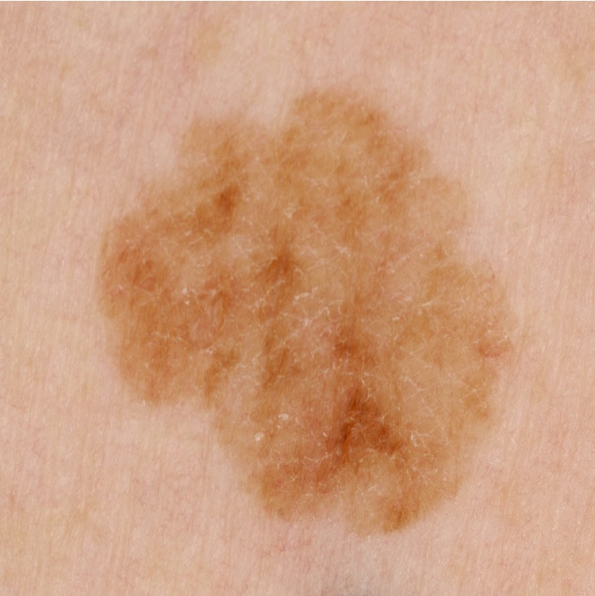 Vlakke verruca seborrhoica