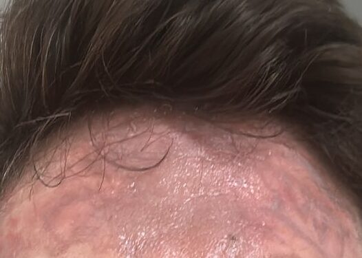 Tijdelijke bijwerkingen