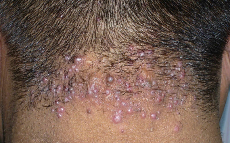 Acne keloidalis nuchae